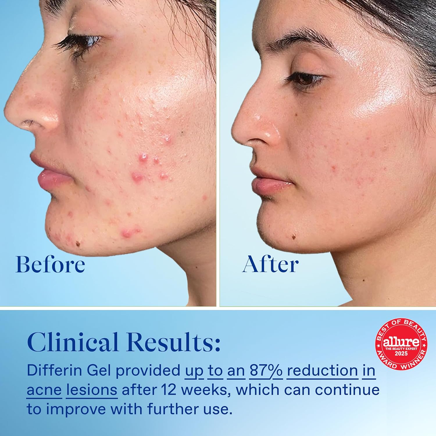 Differin Acne Treatment Gel, 60 Day Supply, Retinoid Treatment for Face with 0.1% Adapalene, Gentle Skin Care for Acne Prone Sensitive Skin, 15g Tube (Pack of 2) (Packaging May Vary) - Image 6