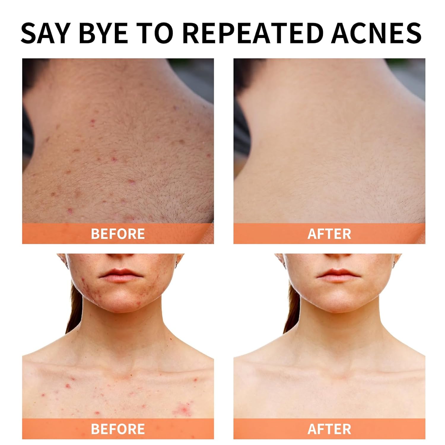 Acne Treatment for Face for Hormonal Cystic Stubborn Acne Cream for Sensitive Skin Teens Adults Women Men Spot Pimple Butt Control Rapid Clearing Breakout Overnight Face Blemish Treatment - Image 5