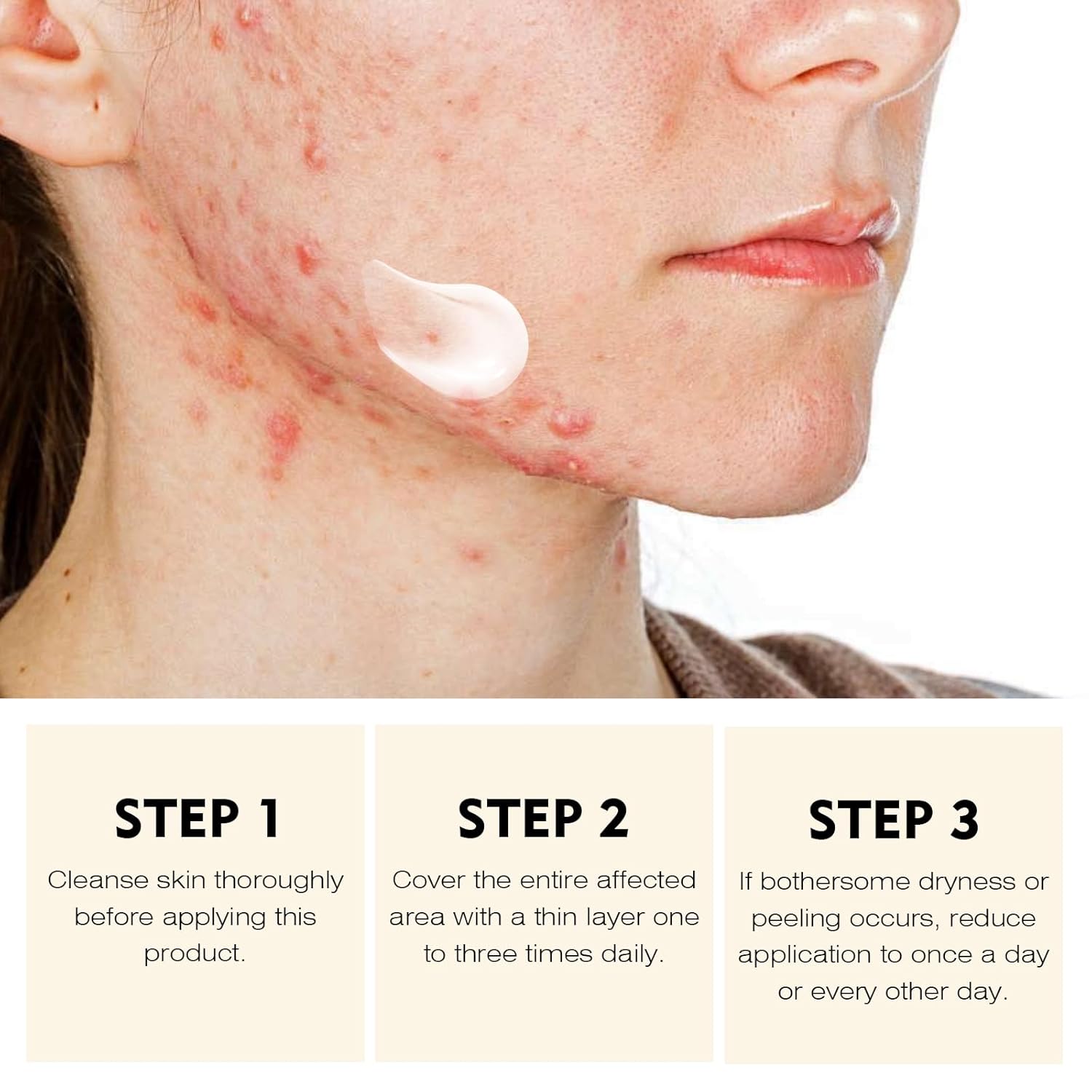 Acne Treatment for Face for Hormonal Cystic Stubborn Acne Cream for Sensitive Skin Teens Adults Women Men Spot Pimple Butt Control Rapid Clearing Breakout Overnight Face Blemish Treatment - Image 4