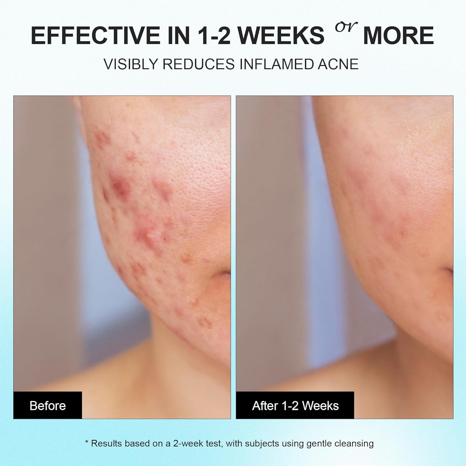 Acne Pimple Spot Treatment Cream: Cystic Hormonal Breakouts Control for Face & Back - 2% Salicylic Acid, Fast Redness Relief, Fades Blemishes & Post-Acne Marks, Teens-Adults, 1.8 oz - Image 3