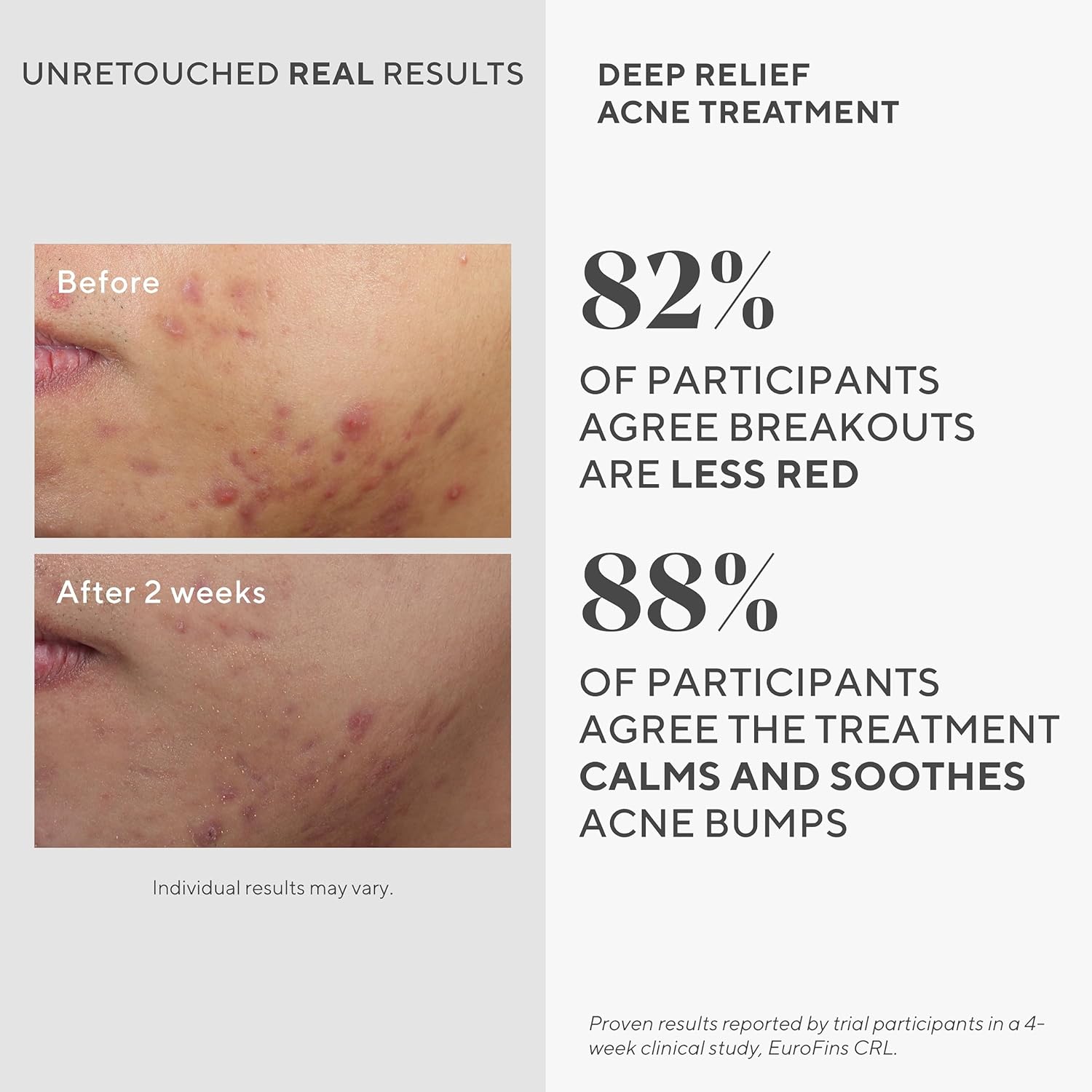 Murad Deep Relief Acne Treatment with 2% Salicylic Acid - Deep, Painful Acne Spot Treatment for Face – Redness Relief, Fast Acting Blemish Serum, Soothing Breakout Treatment - 1Fl Oz - Image 4