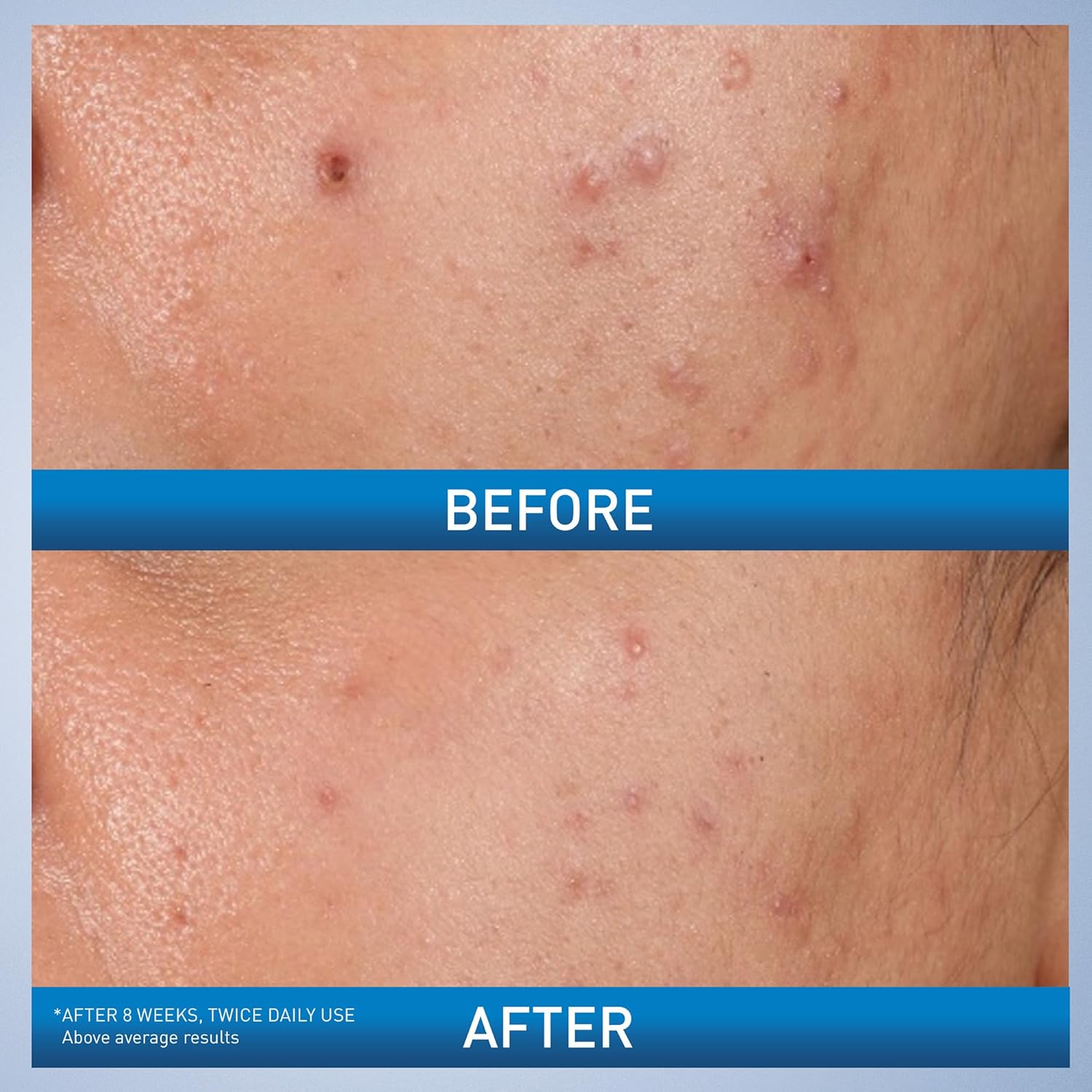 CeraVe Acne Control Gel, 2% Salicylic Acid Treatment With Glycolic Acid + Lactic Acids + Niacniamide, Acne Gel Helps Clear Blemishes Without Over Drying, Alcohol Free & Oil Free, 1.35 Fl Oz - Image 2