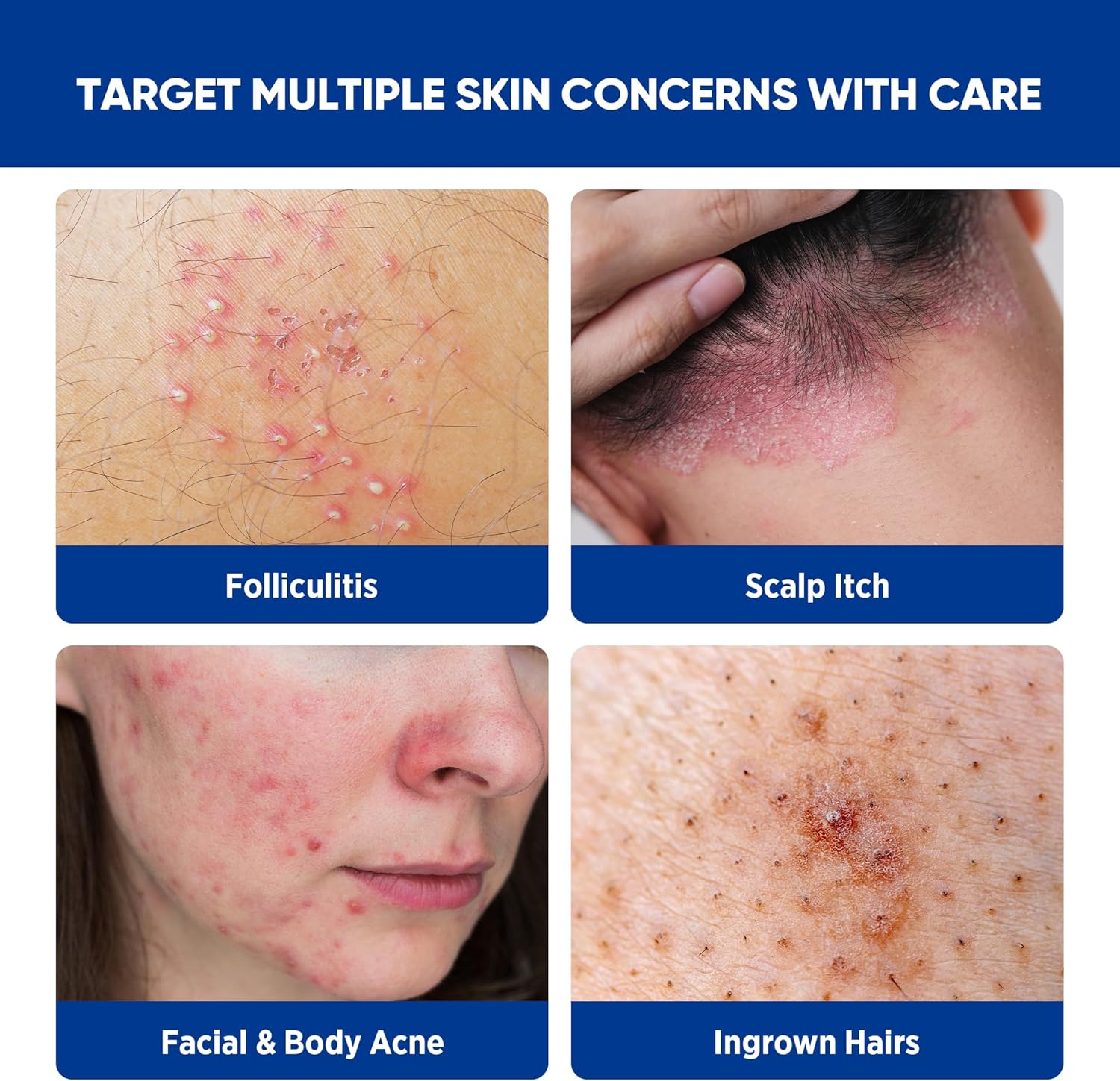 Folliculitis & Acne Treatment Cream – Salicylic Acid & Herbal Extracts for Scalp, Face, Body & Back – Soothes Irritated Skin, Redness & Itch Relief – 100g (Pack of 1) - Image 4