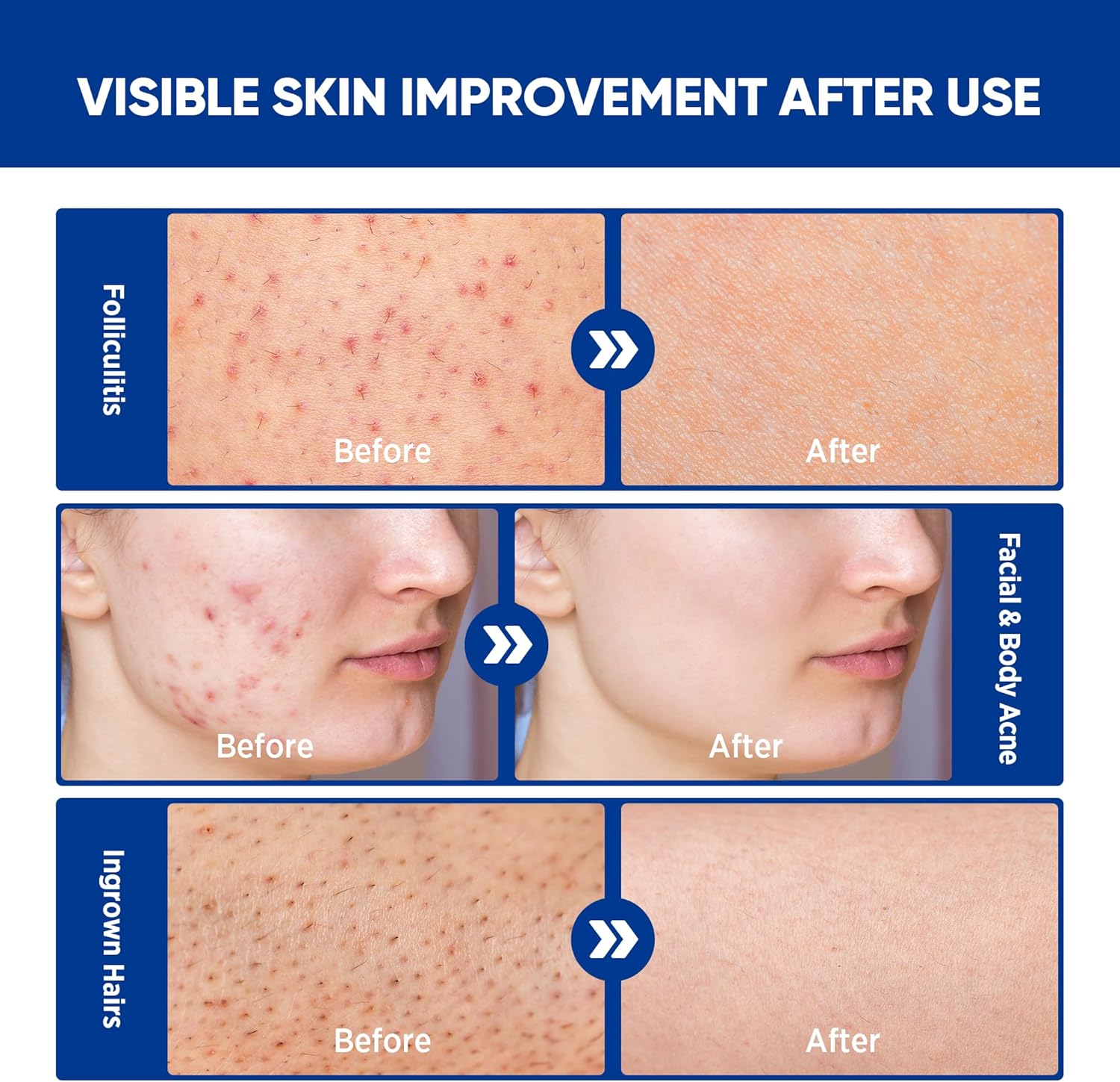 Folliculitis & Acne Treatment Cream – Salicylic Acid & Herbal Extracts for Scalp, Face, Body & Back – Soothes Irritated Skin, Redness & Itch Relief – 100g (Pack of 1) - Image 5