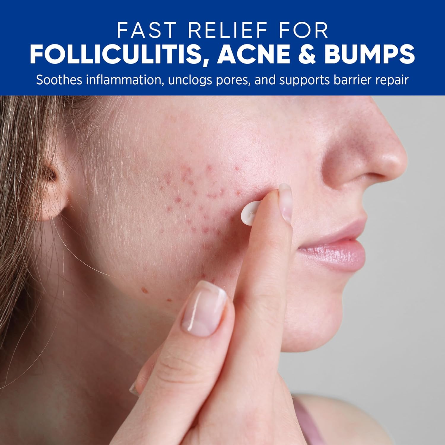 Folliculitis & Acne Treatment Cream – Salicylic Acid & Herbal Extracts for Scalp, Face, Body & Back – Soothes Irritated Skin, Redness & Itch Relief – 100g (Pack of 1) - Image 2