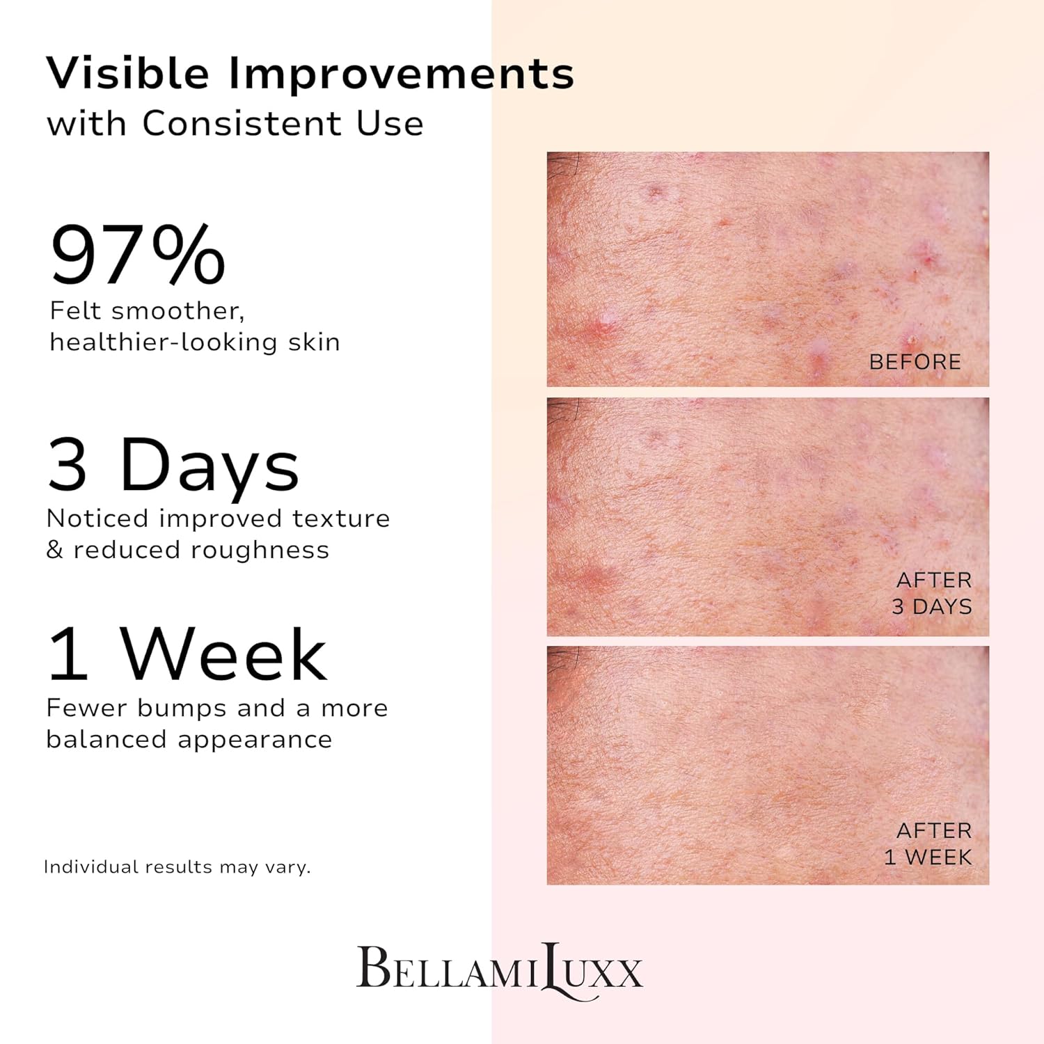 Butt Acne Treatment Set: Acne Soap Bar + Butt Treatment Lotion for Breakouts on Buttocks, Thighs, Back, Chest & Ingrown-Prone & Folliculitis-Prone Skin – Helps Reduce Body Breakouts - Image 3