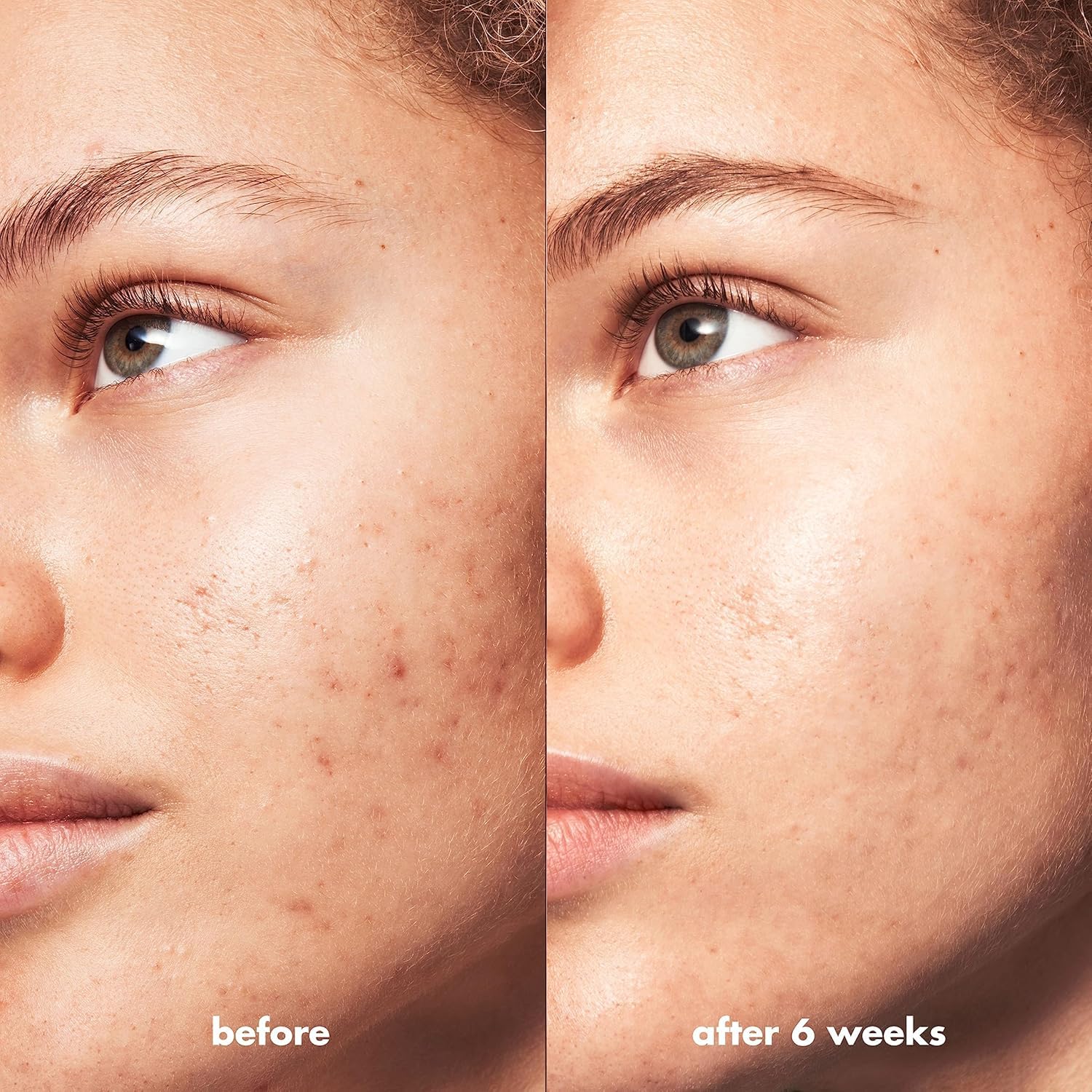 e.l.f. SKIN Blemish Breakthrough Triple-Acid Resurfacing Serum, Hydrating Night Serum For Fighting Blemishes, Helps Improve Skin Tone & Texture - Image 4